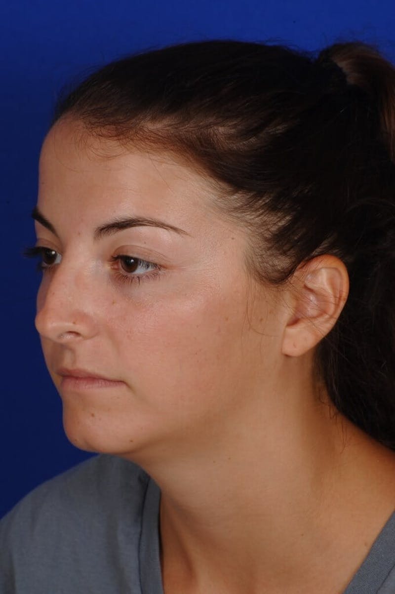 Chin Augmentation Before & After Gallery - Patient 135949 - Image 7