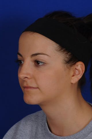 Chin Augmentation Before & After Gallery - Patient 135949 - Image 8
