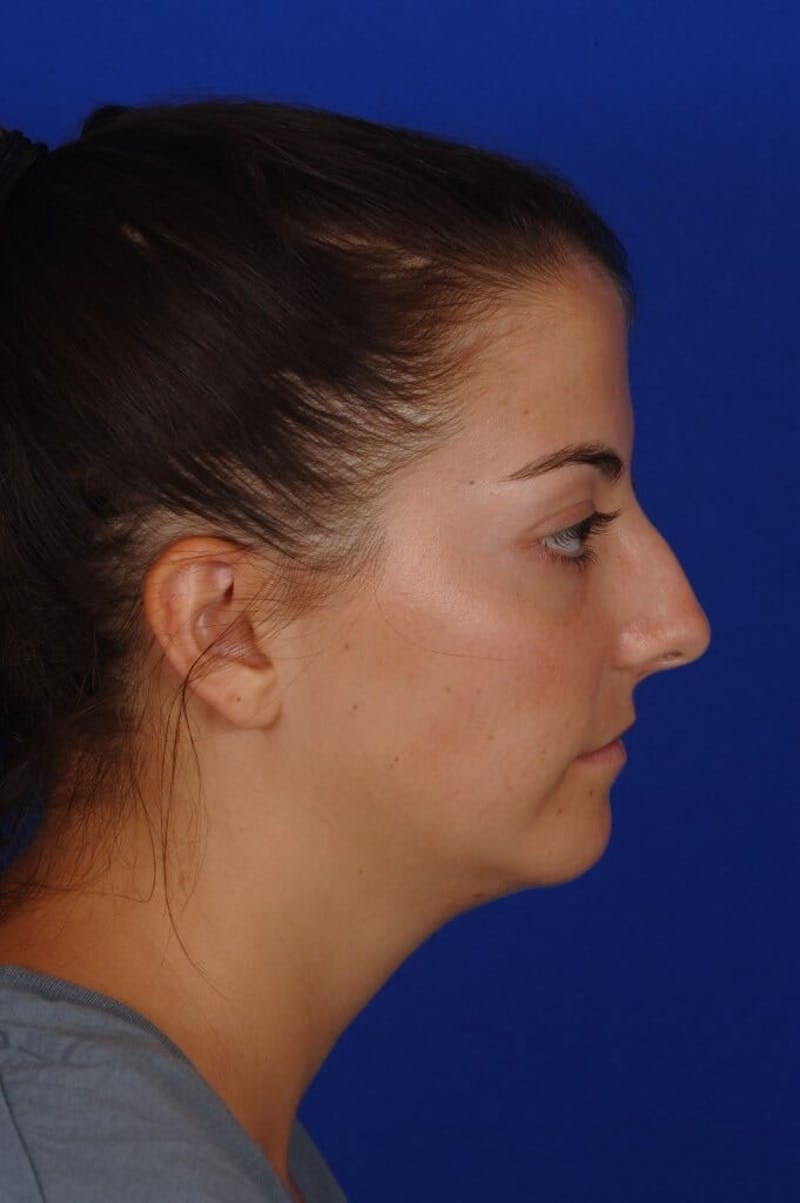 Chin Augmentation Before & After Gallery - Patient 135949 - Image 9