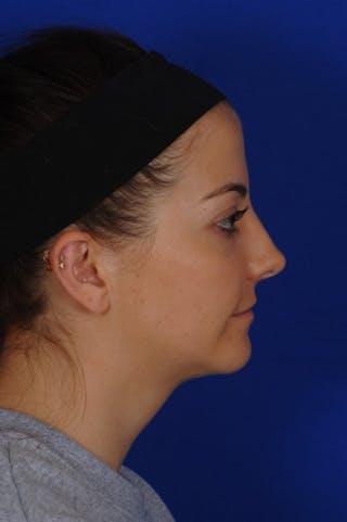 Chin Augmentation Before & After Gallery - Patient 135949 - Image 10