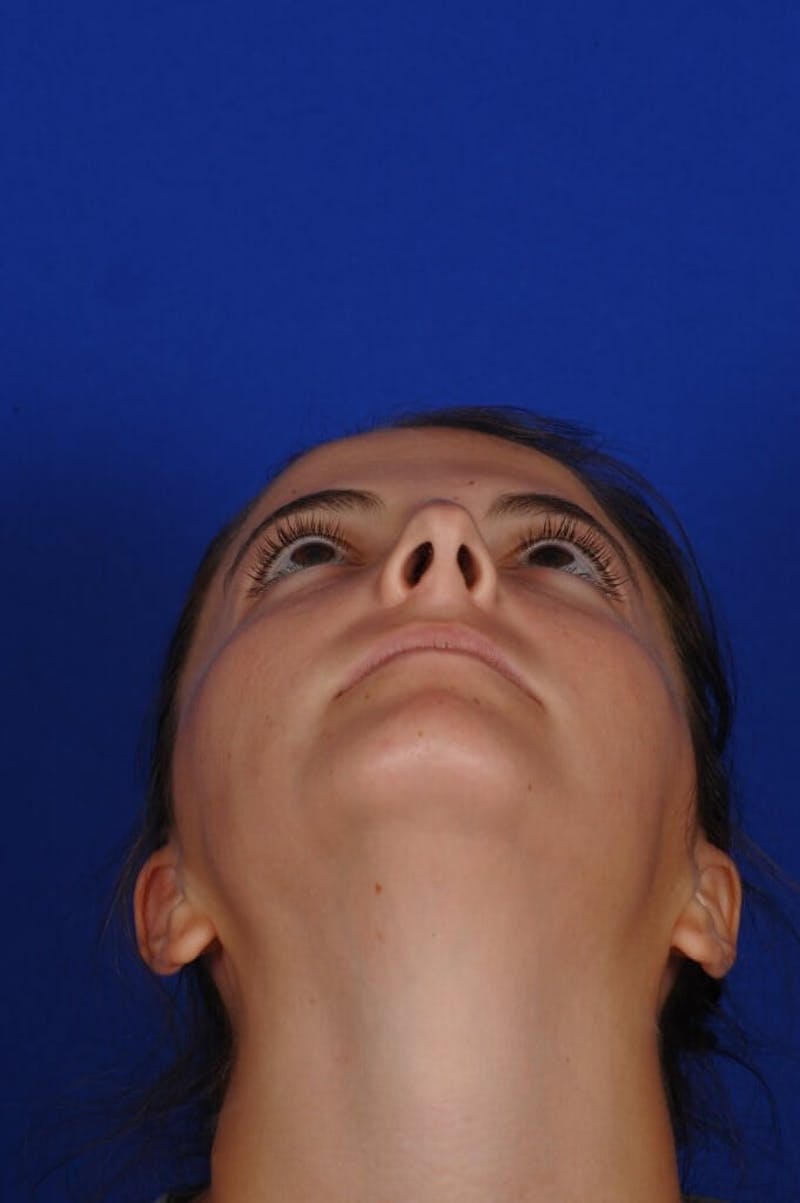 Chin Augmentation Before & After Gallery - Patient 135949 - Image 11
