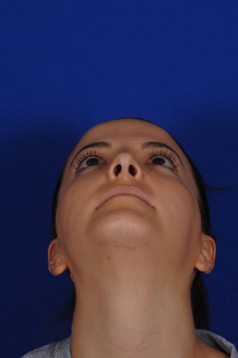 Chin Augmentation Before & After Gallery - Patient 135949 - Image 12