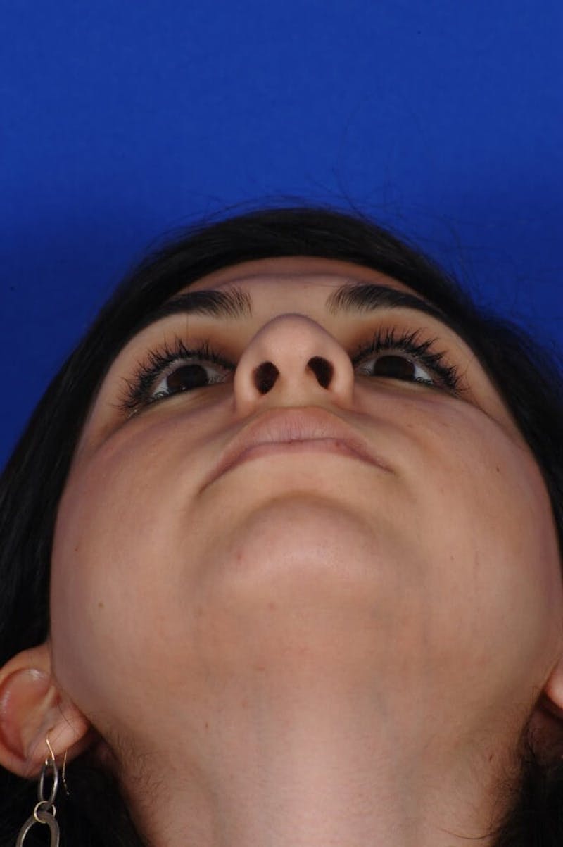 Chin Augmentation Before & After Gallery - Patient 285802 - Image 11
