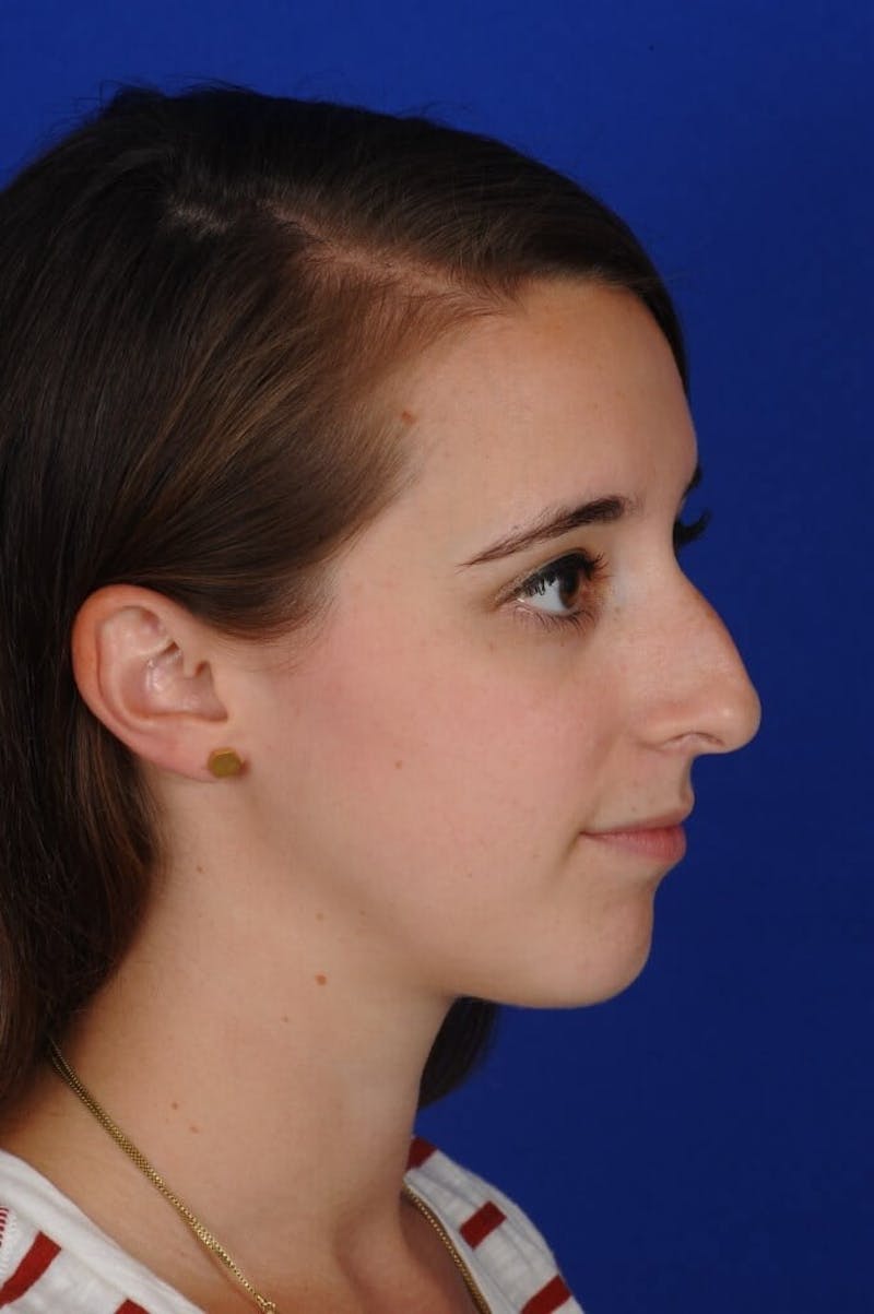 Chin Augmentation Before & After Gallery - Patient 351451 - Image 1