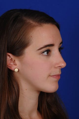 Chin Augmentation Before & After Gallery - Patient 351451 - Image 2