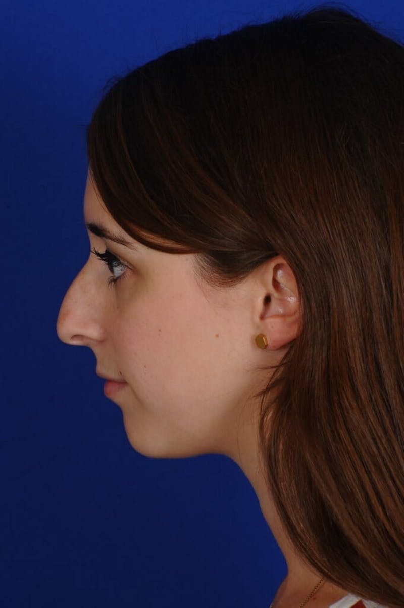 Chin Augmentation Before & After Gallery - Patient 351451 - Image 3