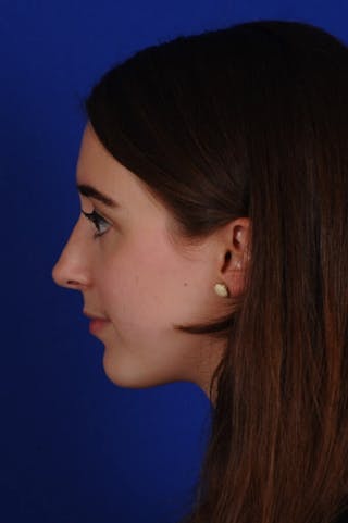 Chin Augmentation Before & After Gallery - Patient 351451 - Image 4