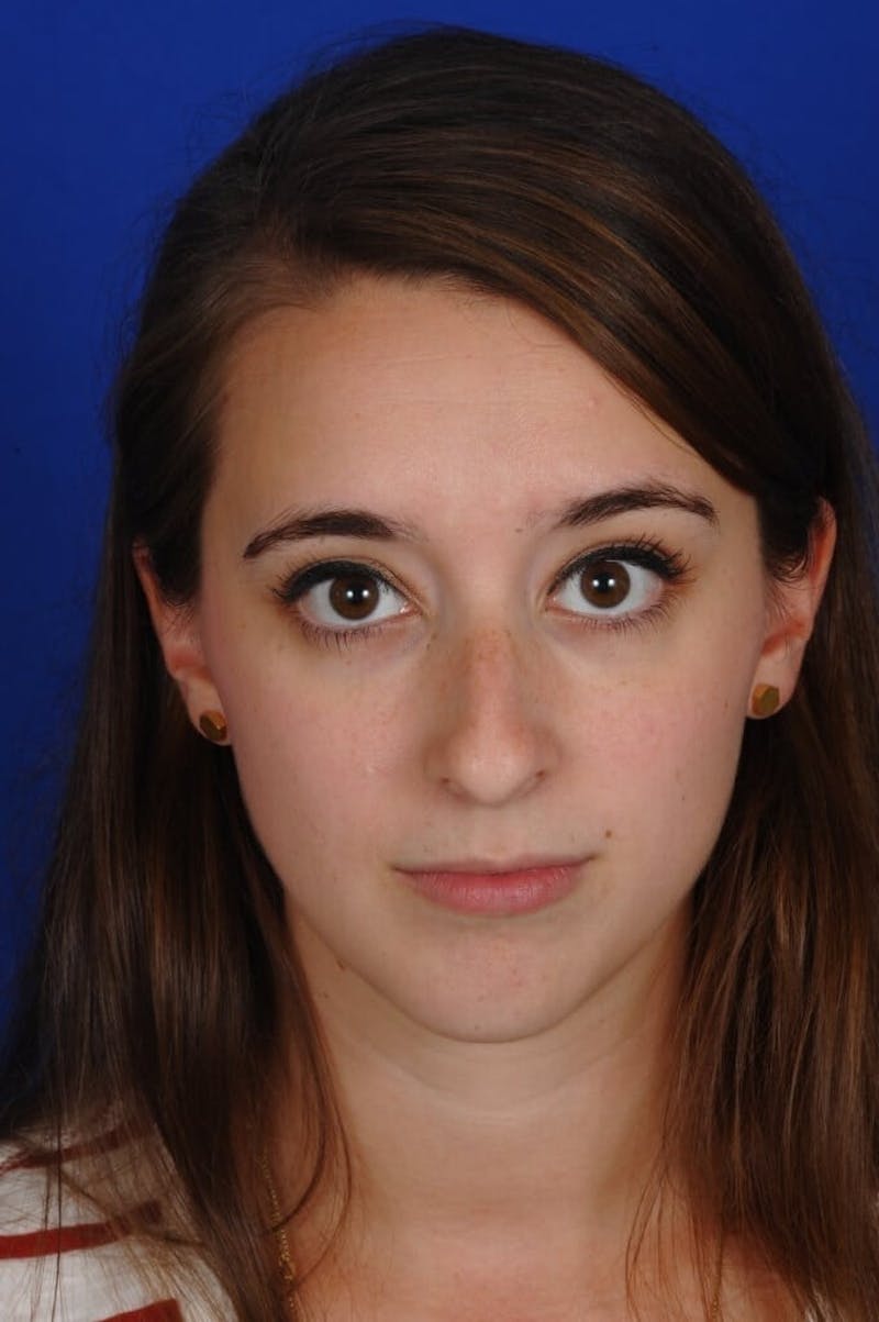 Chin Augmentation Before & After Gallery - Patient 351451 - Image 5