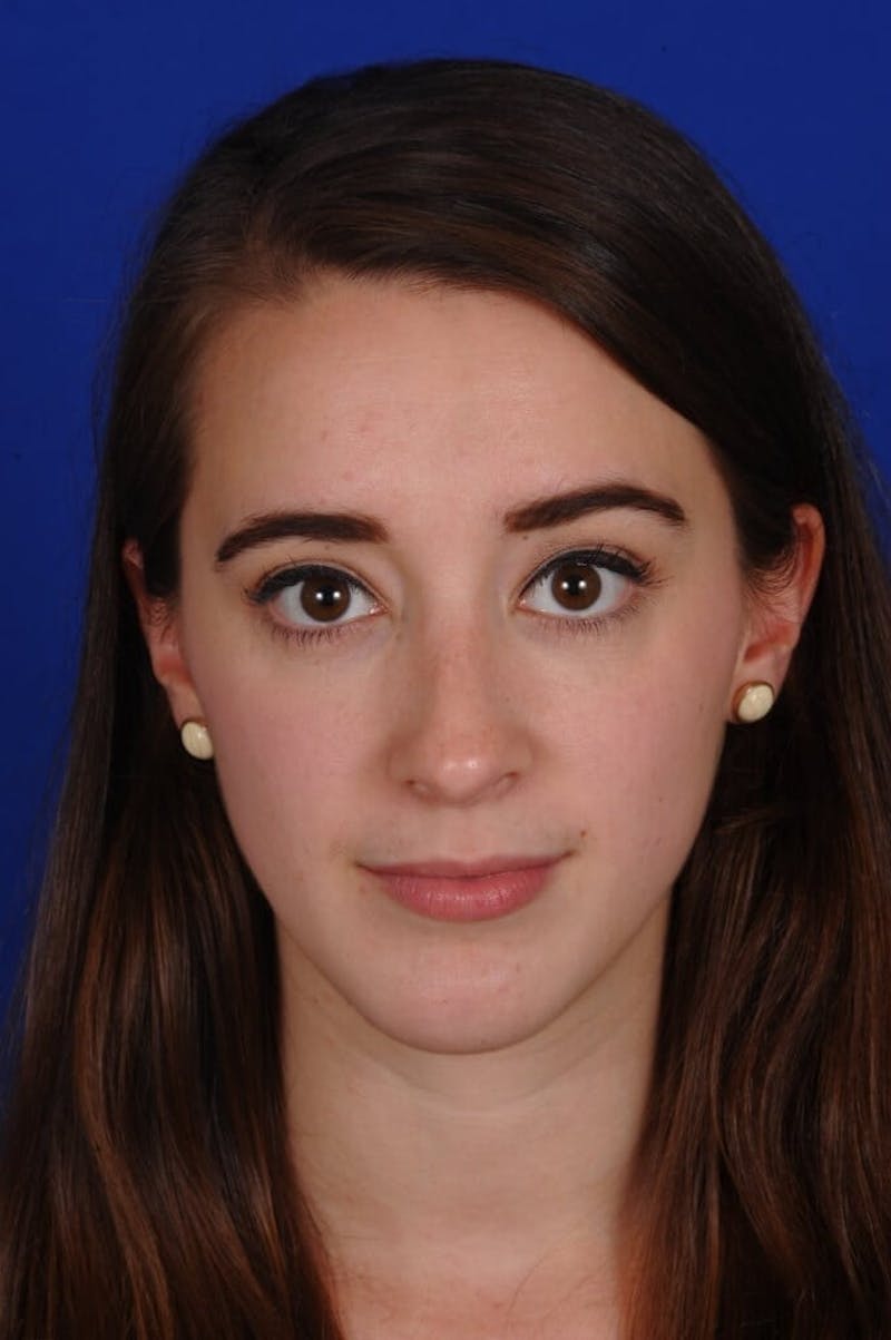 Chin Augmentation Before & After Gallery - Patient 351451 - Image 6