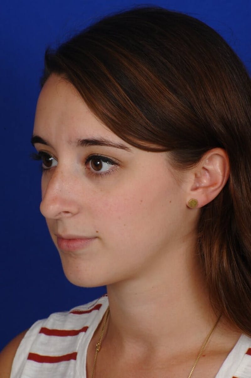 Chin Augmentation Before & After Gallery - Patient 351451 - Image 7