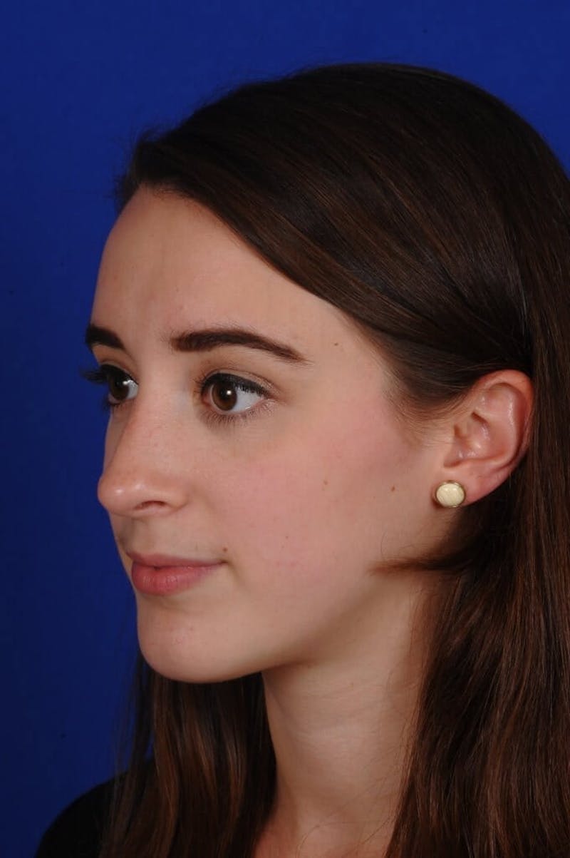 Chin Augmentation Before & After Gallery - Patient 351451 - Image 8