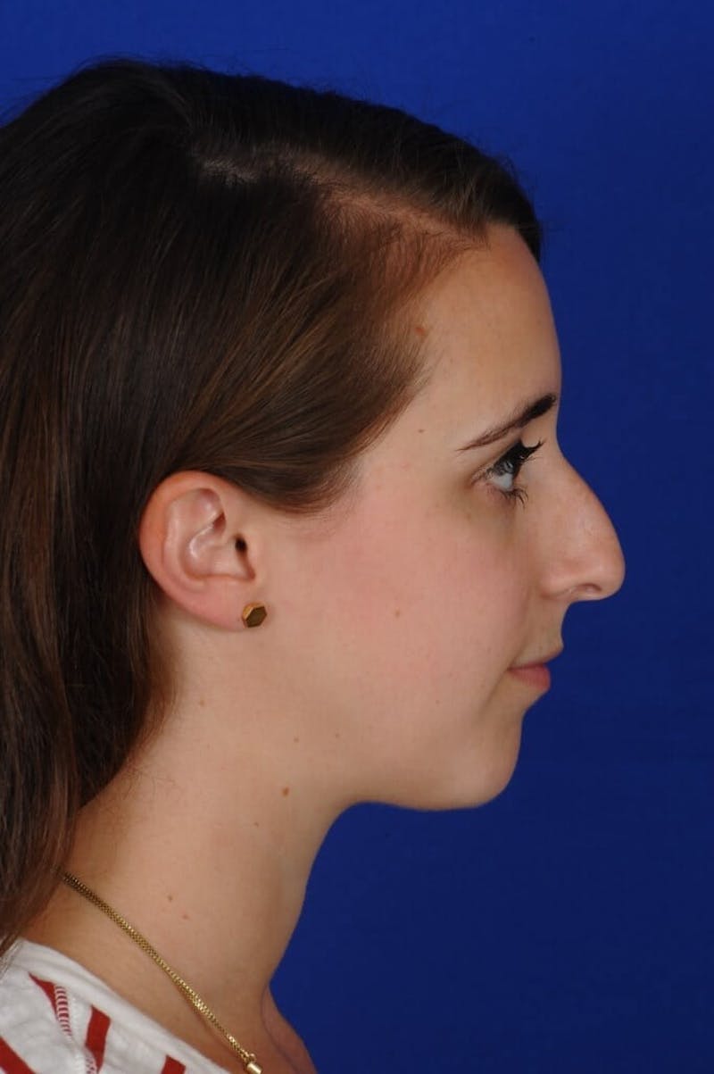 Chin Augmentation Before & After Gallery - Patient 351451 - Image 9