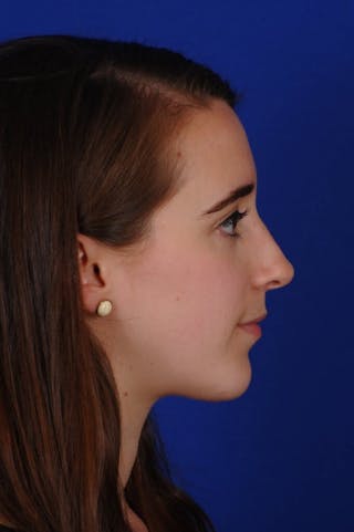 Chin Augmentation Before & After Gallery - Patient 351451 - Image 10