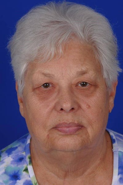 Eyelid Surgery Before & After Gallery - Patient 238037 - Image 1