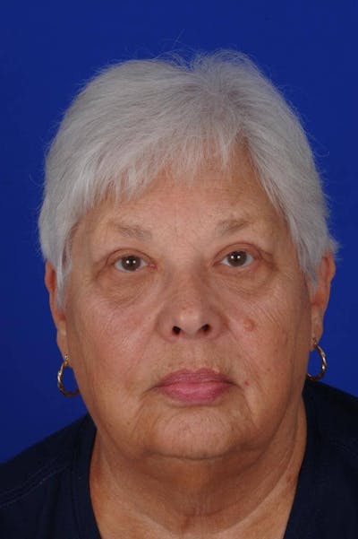 Eyelid Surgery Before & After Gallery - Patient 238037 - Image 2