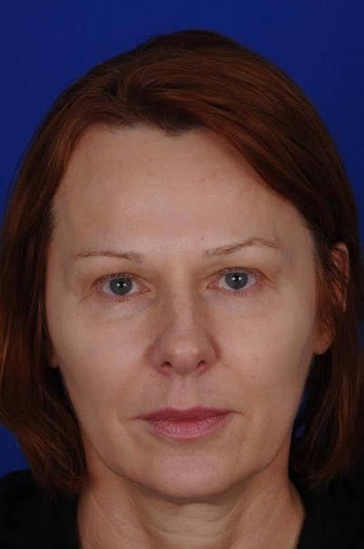 Eyelid Surgery Before & After Gallery - Patient 331754 - Image 1