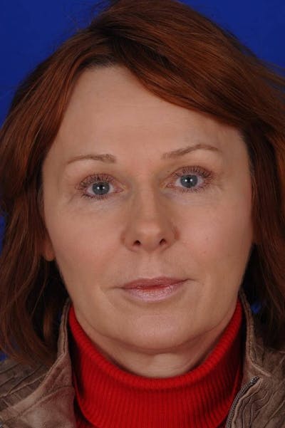Eyelid Surgery Before & After Gallery - Patient 331754 - Image 2