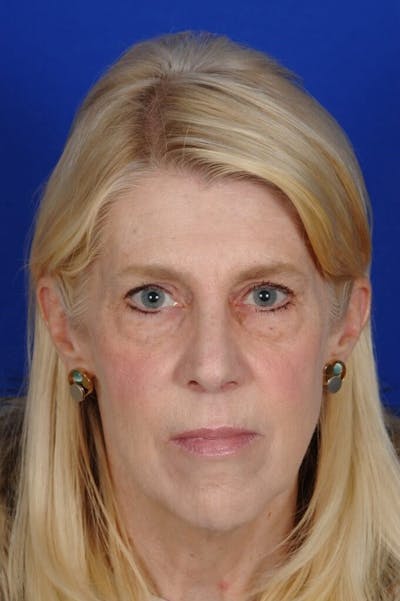 Eyelid Surgery Before & After Gallery - Patient 119085 - Image 1