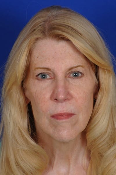 Eyelid Surgery Before & After Gallery - Patient 119085 - Image 2