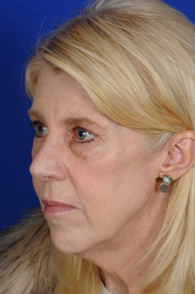 Eyelid Surgery Before & After Gallery - Patient 119085 - Image 3