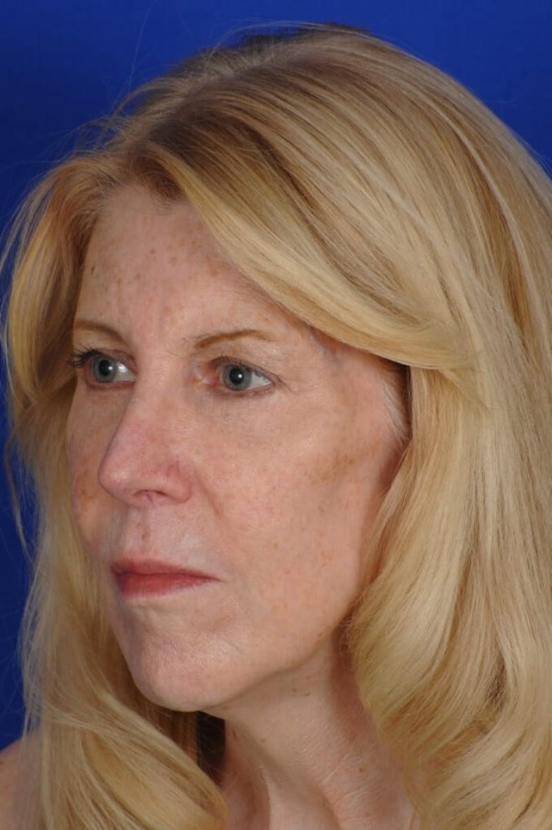 Eyelid Surgery Before & After Gallery - Patient 119085 - Image 4