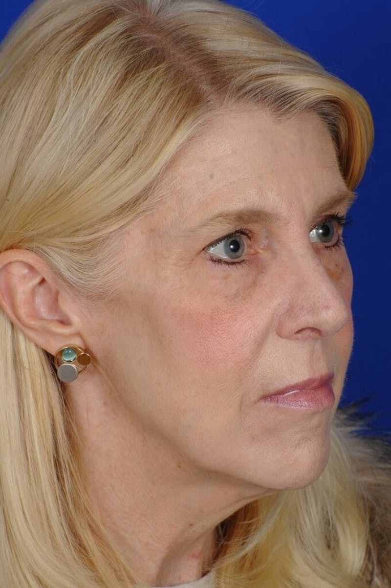 Eyelid Surgery Before & After Gallery - Patient 119085 - Image 5