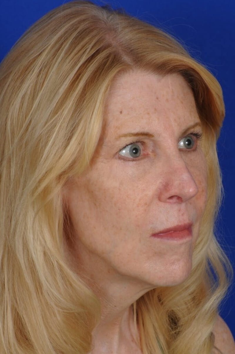 Eyelid Surgery Before & After Gallery - Patient 119085 - Image 6