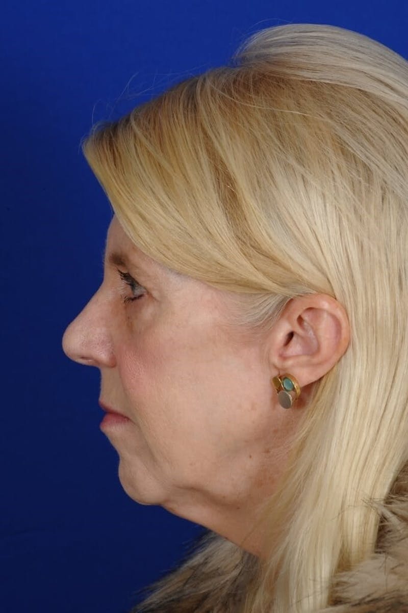 Eyelid Surgery Before & After Gallery - Patient 119085 - Image 7