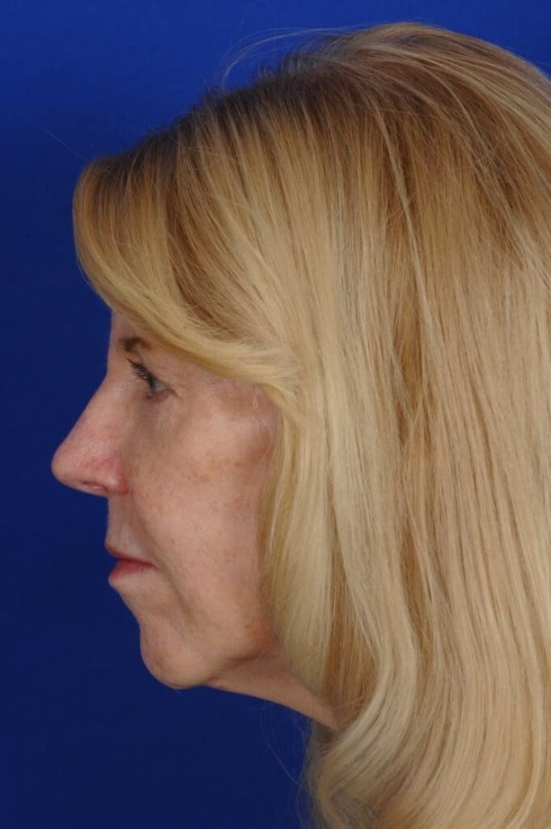 Eyelid Surgery Before & After Gallery - Patient 119085 - Image 8