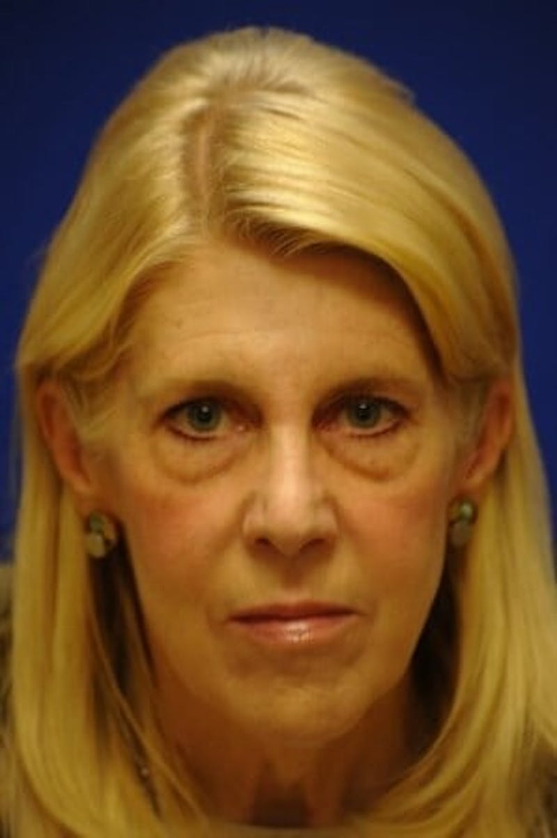 Eyelid Surgery Before & After Gallery - Patient 119085 - Image 9