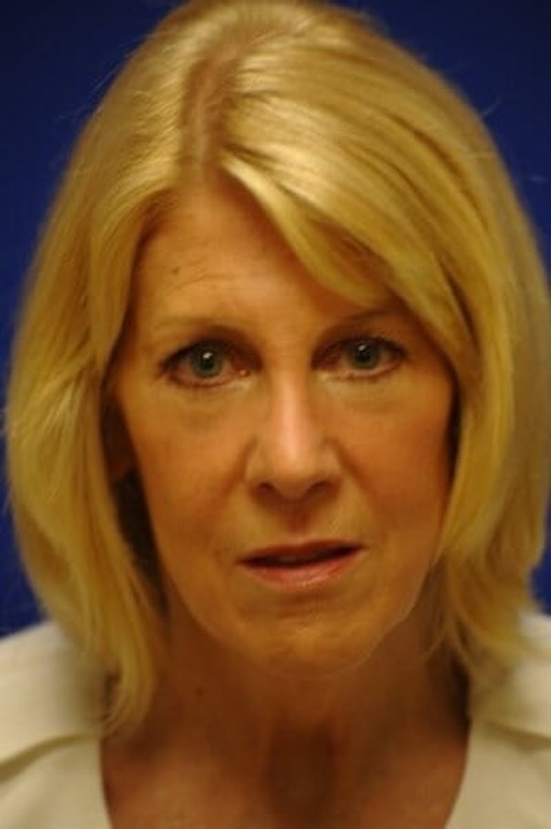 Eyelid Surgery Before & After Gallery - Patient 119085 - Image 10