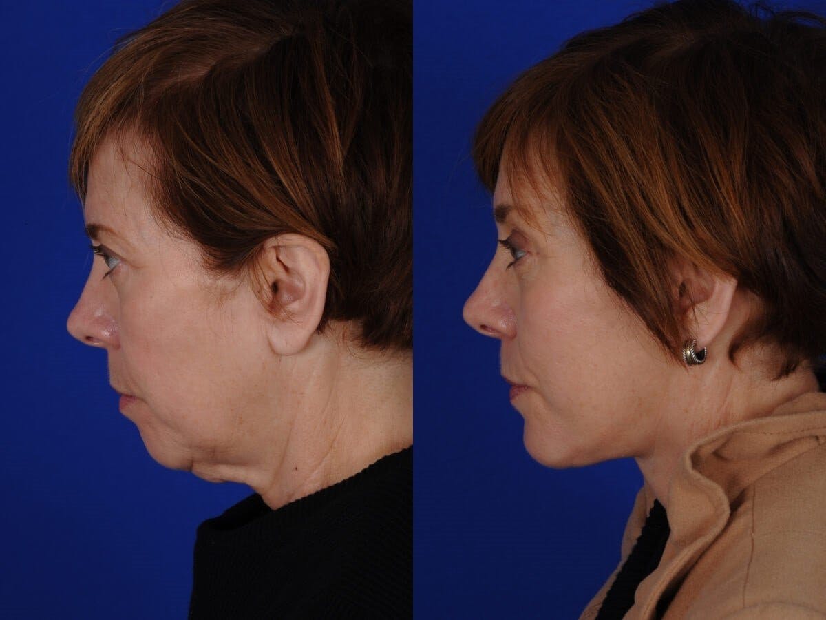 Facelift Before & After Gallery - Patient 103960 - Image 2