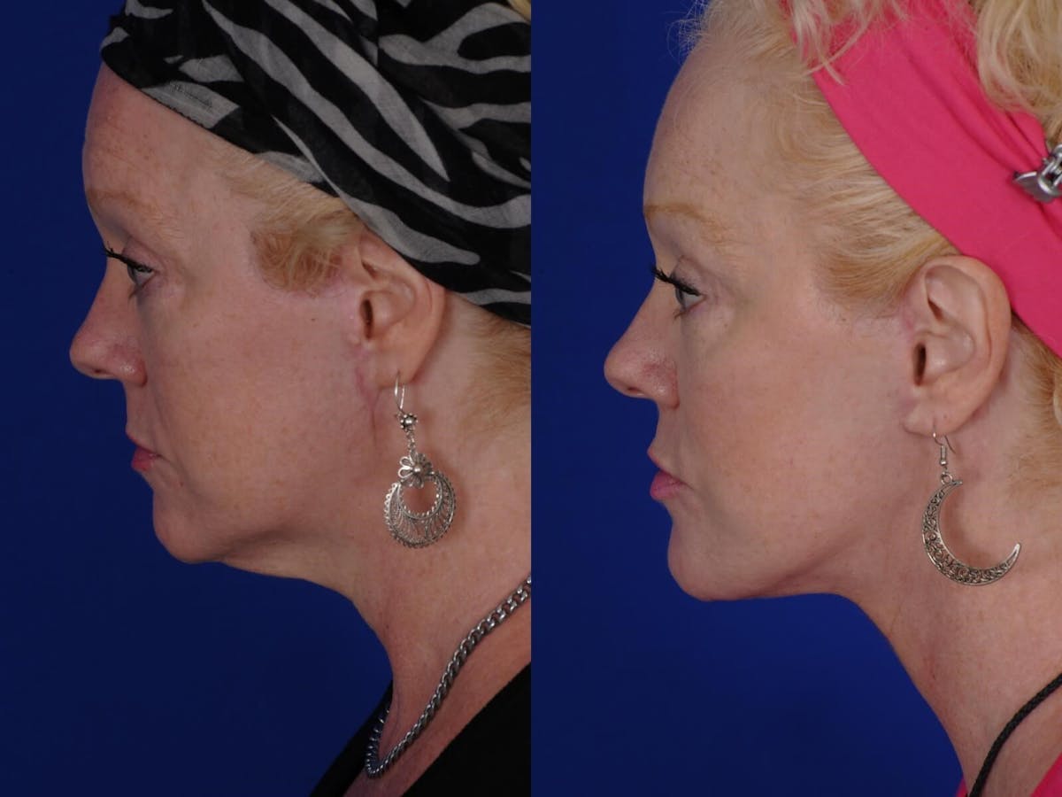 Facelift Before & After Gallery - Patient 211727 - Image 1