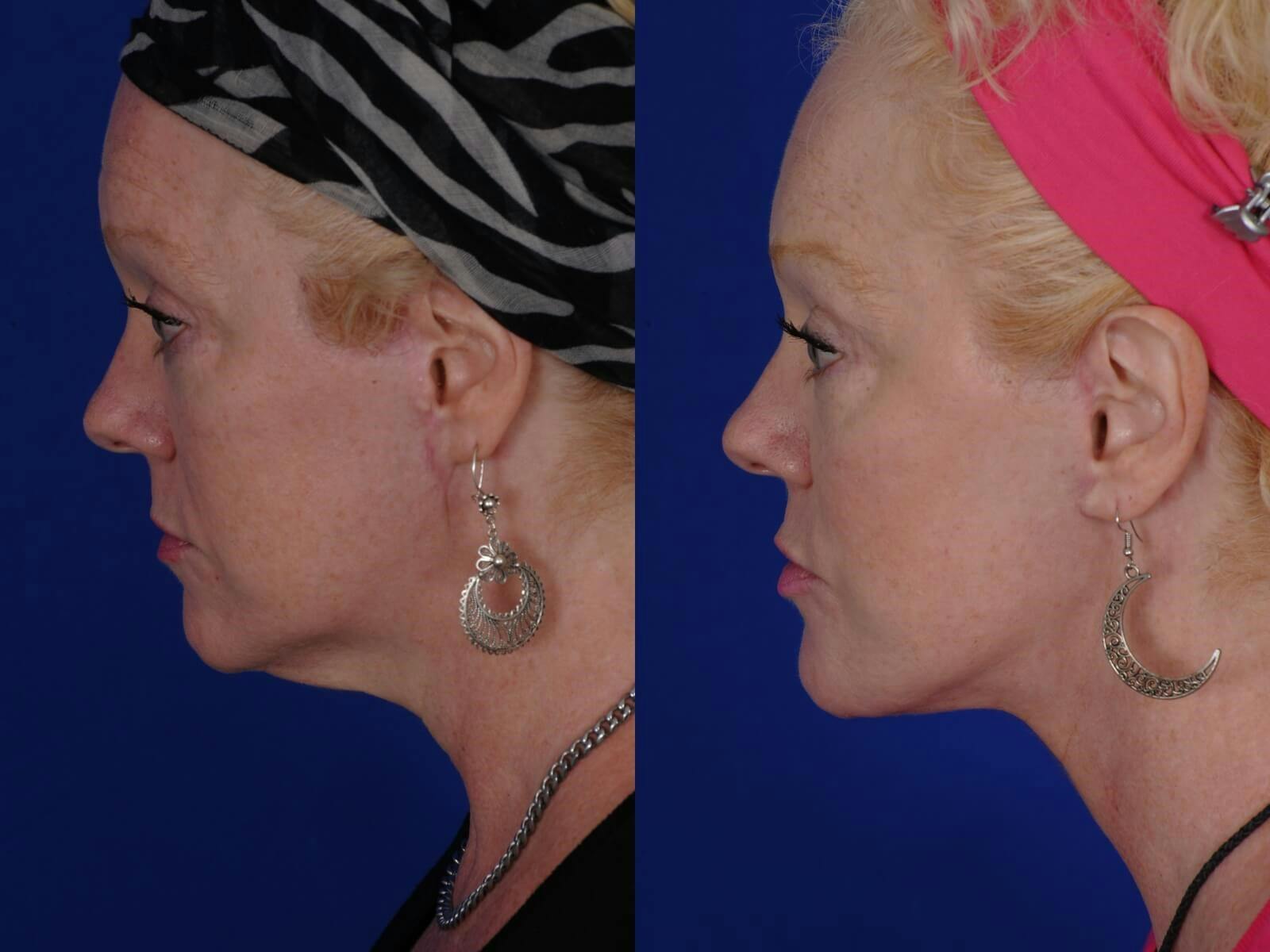 Facelift Before & After Gallery - Patient 211727 - Image 1