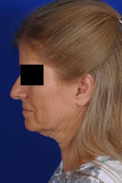 Facelift Before & After Gallery - Patient 103772 - Image 1