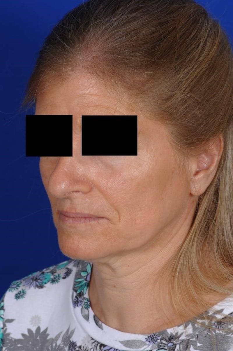 Facelift Before & After Gallery - Patient 103772 - Image 5