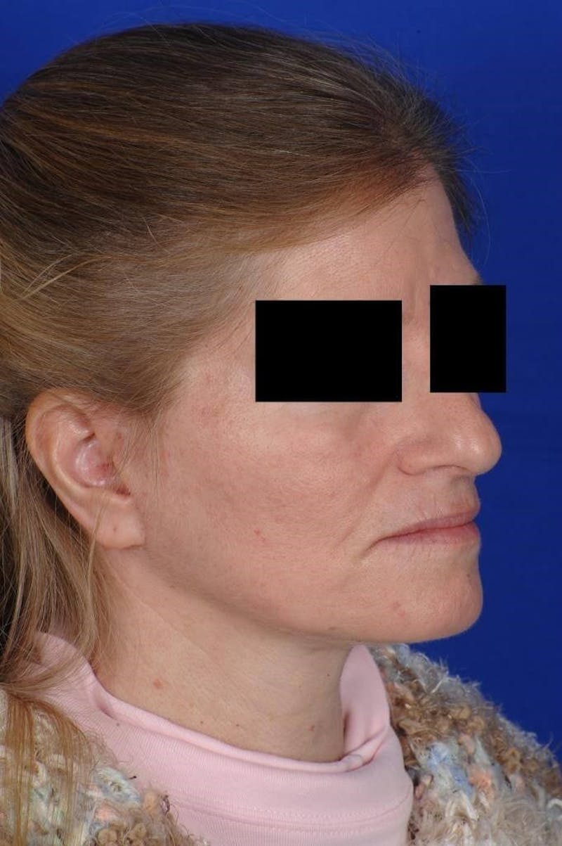 Facelift Before & After Gallery - Patient 103772 - Image 8