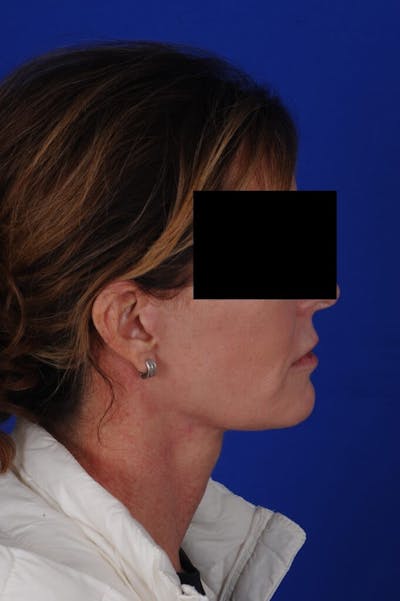 Facelift Before & After Gallery - Patient 234466 - Image 2