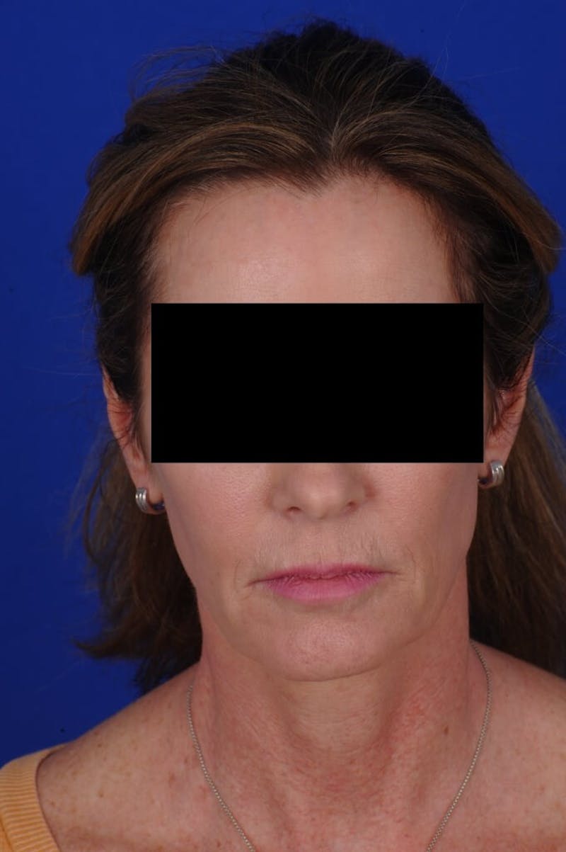Facelift Before & After Gallery - Patient 234466 - Image 3