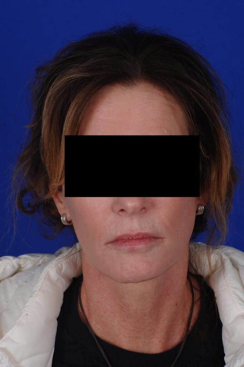Facelift Before & After Gallery - Patient 234466 - Image 4