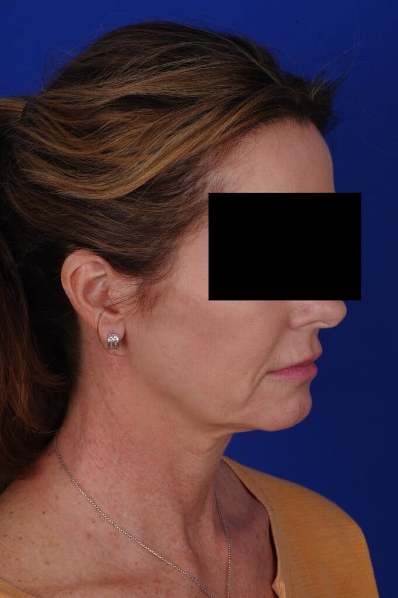 Facelift Before & After Gallery - Patient 234466 - Image 5