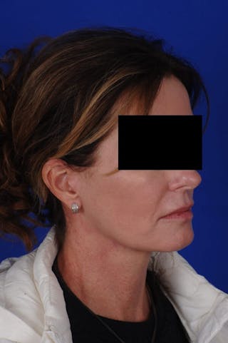 Facelift Before & After Gallery - Patient 234466 - Image 6