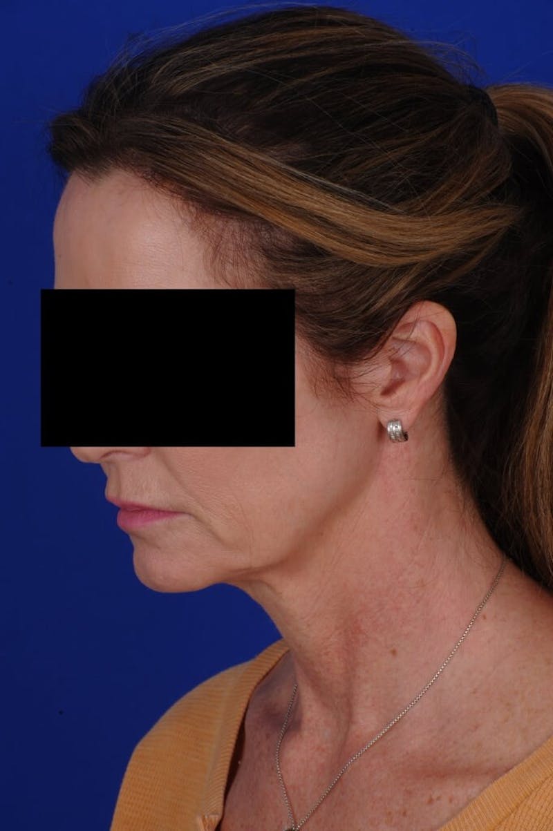 Facelift Before & After Gallery - Patient 234466 - Image 7