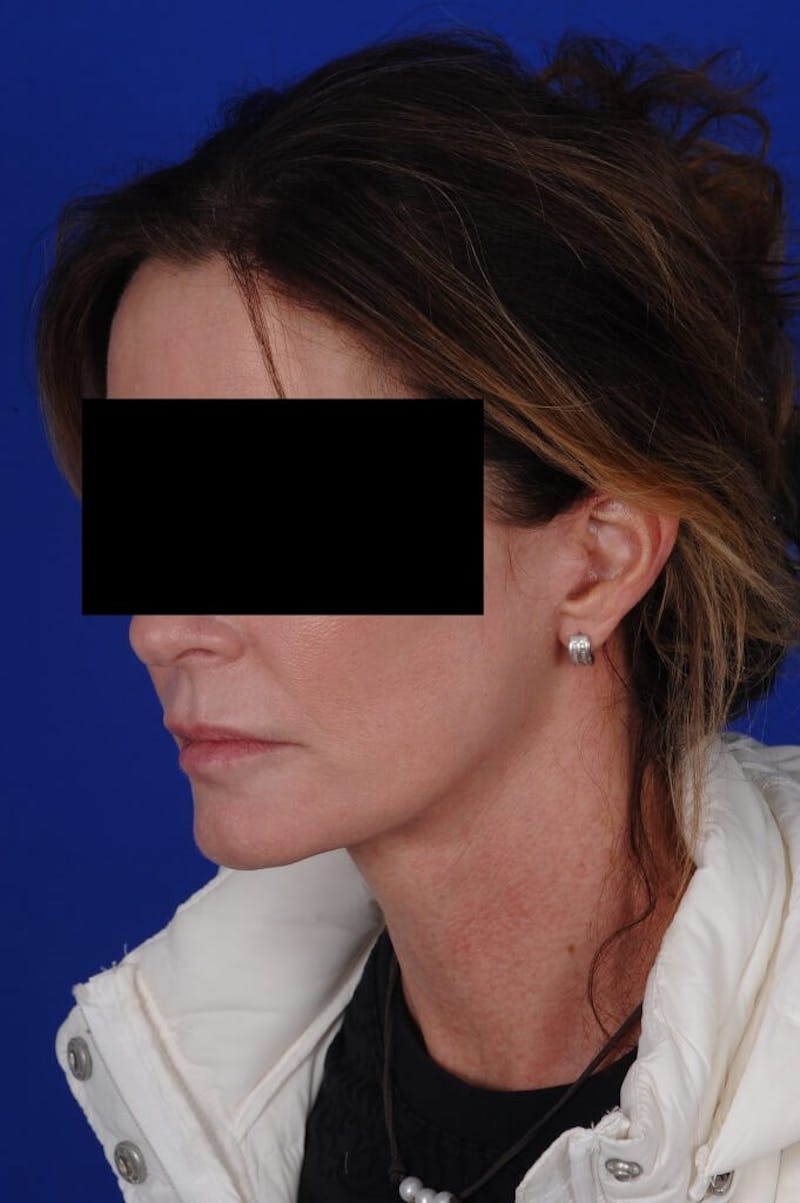 Facelift Before & After Gallery - Patient 234466 - Image 8
