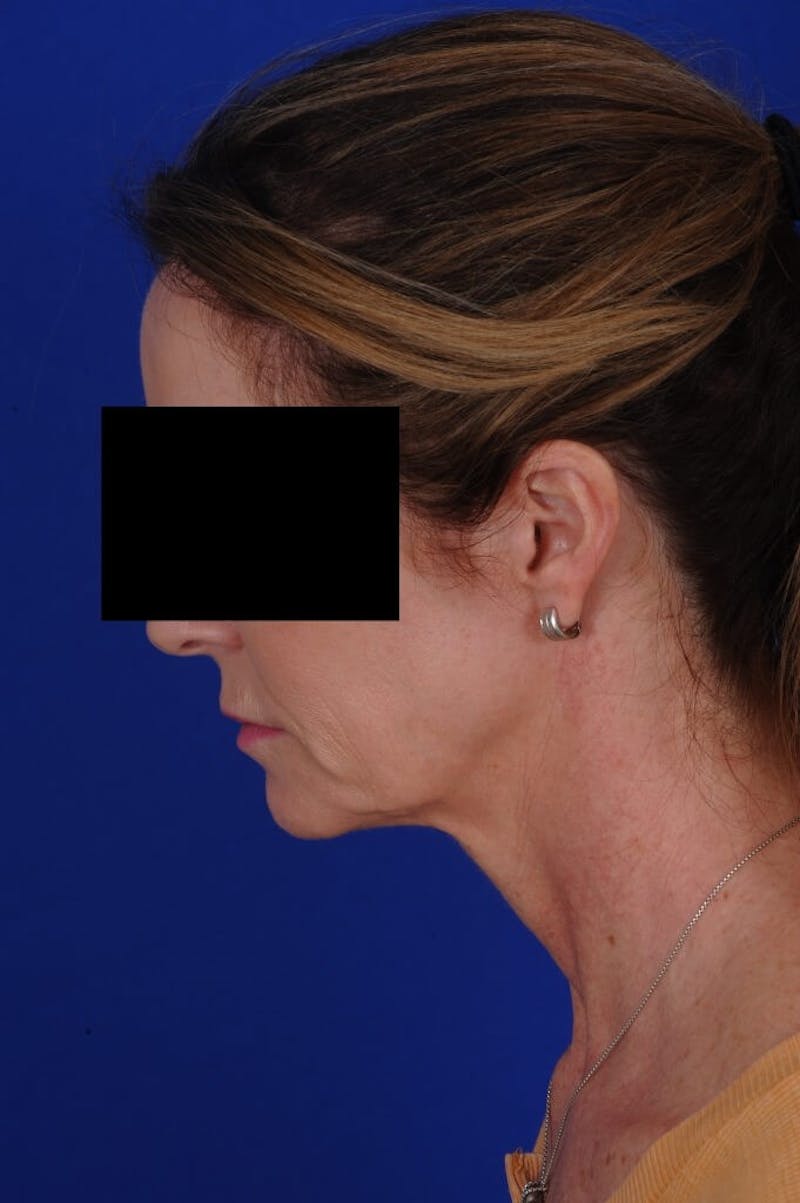 Facelift Before & After Gallery - Patient 234466 - Image 9