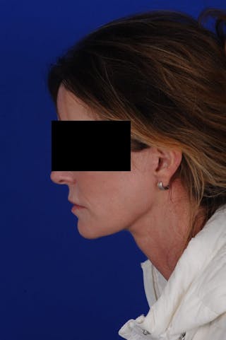 Facelift Before & After Gallery - Patient 234466 - Image 10