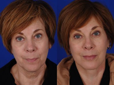 Neck Lift Before & After Gallery - Patient 655163 - Image 1