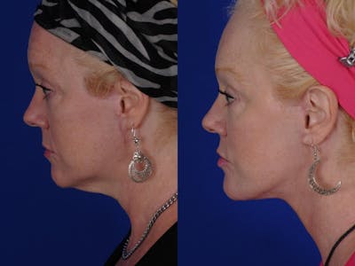 Neck Lift Before & After Gallery - Patient 422363 - Image 1