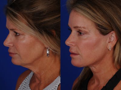 Neck Lift Before & After Gallery - Patient 178687 - Image 1