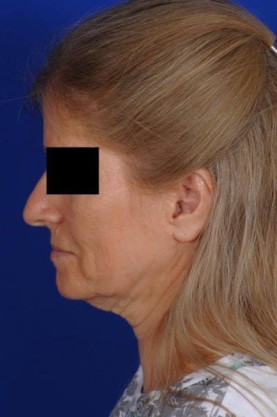 Neck Lift Before & After Gallery - Patient 338310 - Image 1